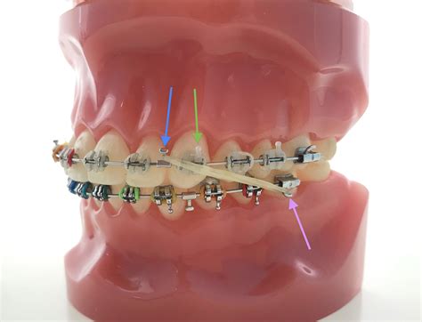 Elastics On Braces