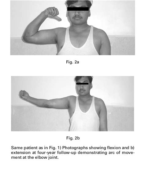 Elbow Fixed Flexion Deformity
