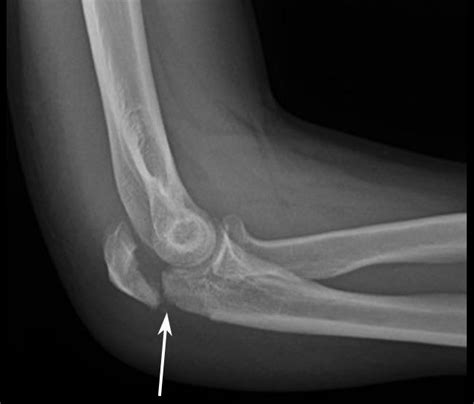 Elbow Fracture X Ray