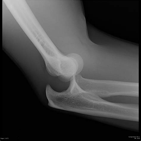 elbow joint dislocation radiology