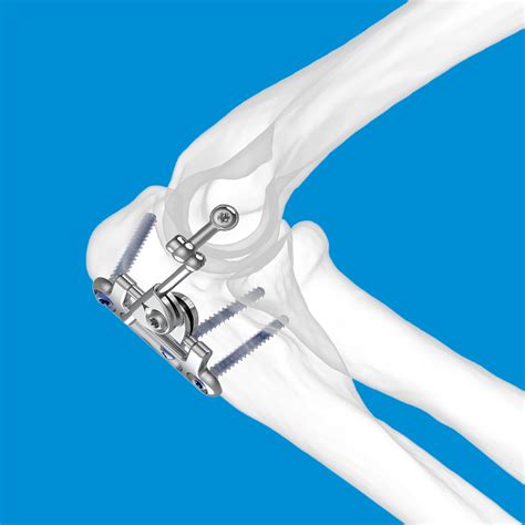 Elbow Surgery Screws