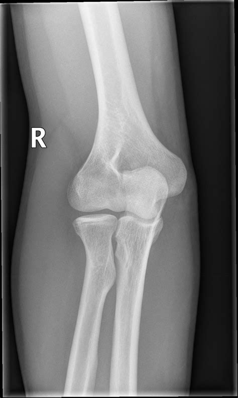 Elbow X Ray