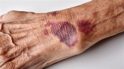 elderly bruising easily