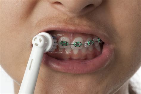 electric braces toothbrush