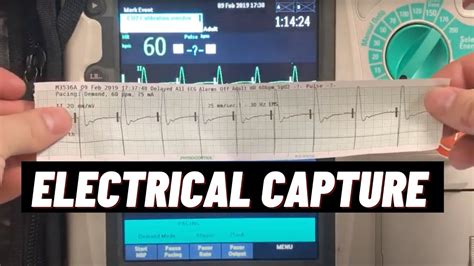Electrical Capture Pacemaker