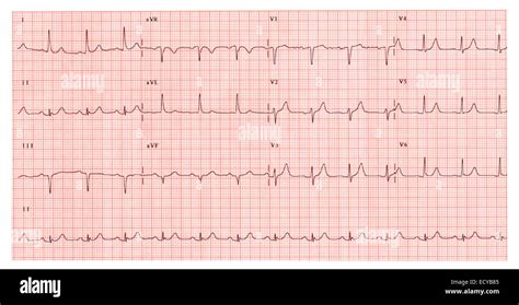 electrocardiograma con ritmo sinusal