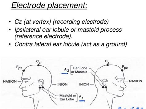 Electrode Placement In Abr