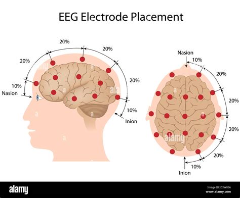 Electrode Placement Seizure