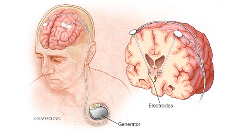 Electrodes Brain Treatment