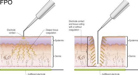 Electrodessication And Curettage Procedure Note