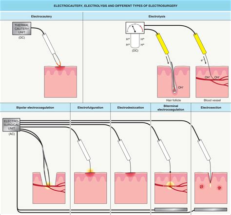 Electrodessication Genital Warts