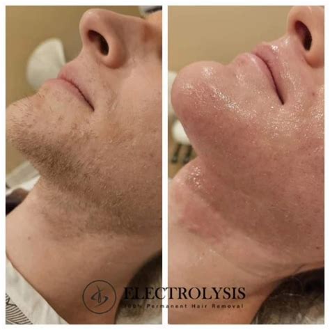 Electrolysis Chicago Il