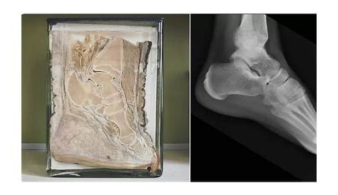 Elephant Foot X Ray Vs Human Pachidermi In Punta Di Piedi… Regno Natura