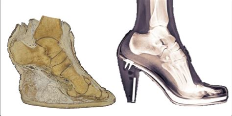 Elephant Foot Bones Vs Human