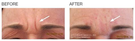 eleven lines on face