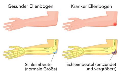What Causes Psoriasis On Elbows