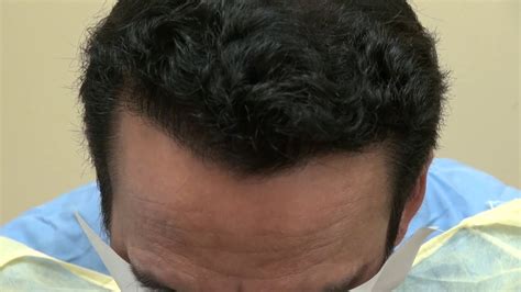 Before & After Pictures of Hair Restoration in Edmonton