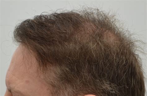 Before & After Pictures of Hair Restoration in Edmonton
