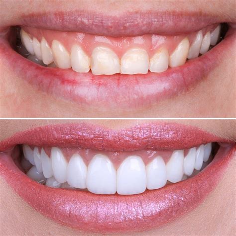 Emax Veneers Turkey