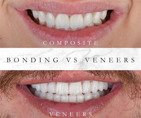 Emax Veneers Vs Composite