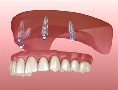 emblemhealth dental implants