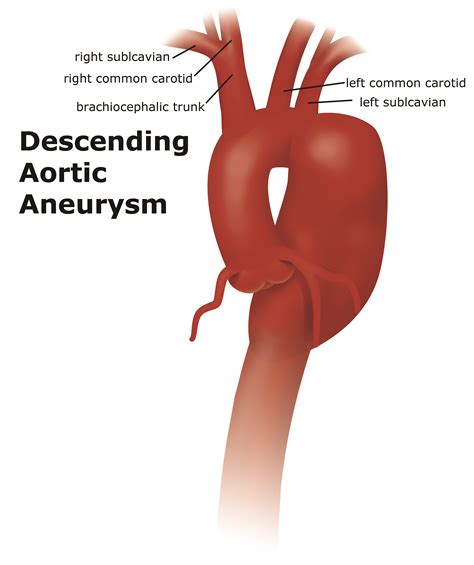 embolism and aneurysm