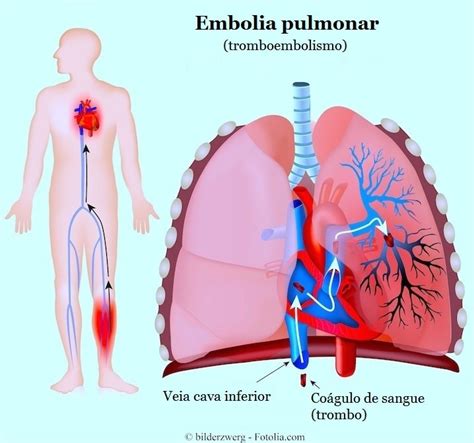 embolismo pulmonar sintomas
