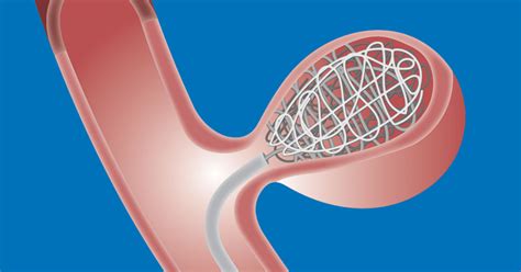 embolization coils mri safety