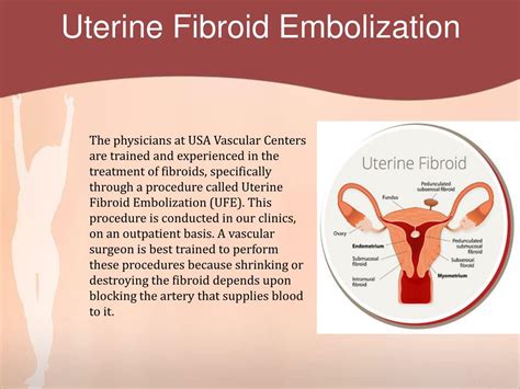 embolization treatment for fibroids