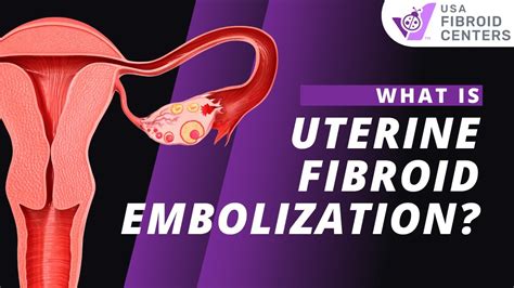 embolization uterine