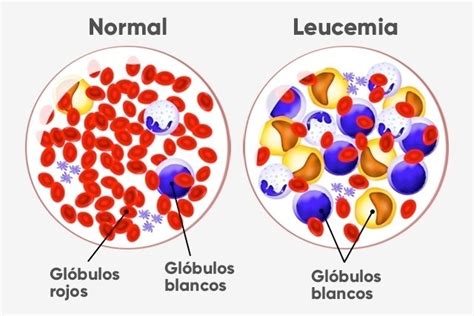 en cuanto tiempo se desarrolla la leucemia