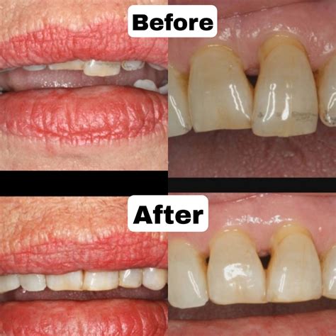 enameloplasty