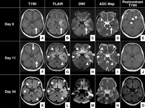 encephalitis ct scan findings