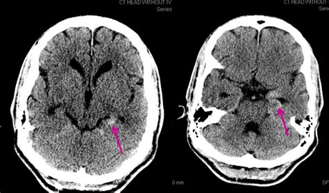 encephalitis on ct scan