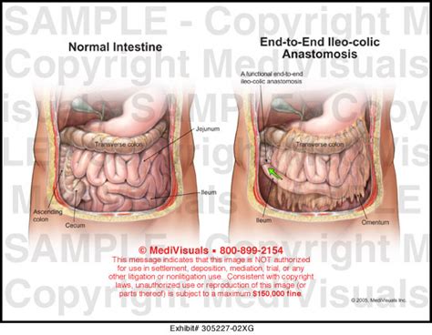 end to end ileocolonic anastomosis