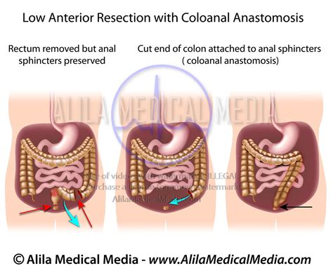 end-to-end colo-colonic anastomosis icd 10