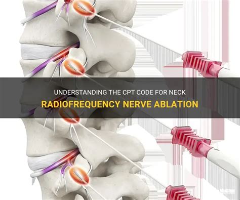 Endo Ablation Procedure Cpt Code