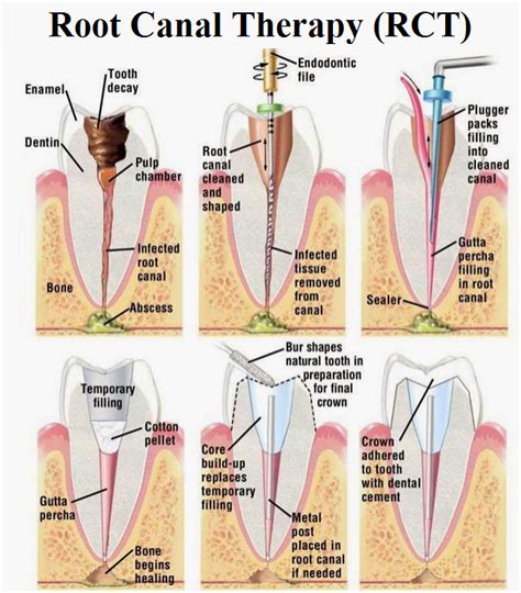 Endo Access Fill Dental Code