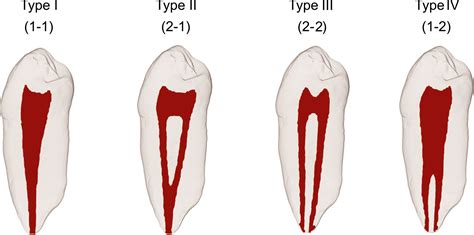 Endo Canal Classification