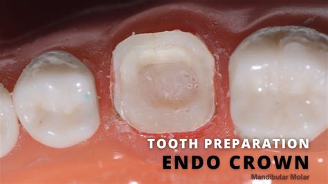 Endo Crown Prep