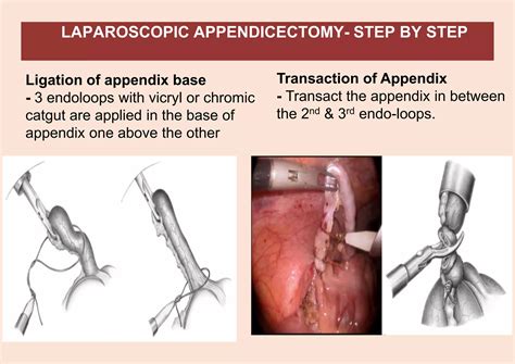 Endo On Appendix