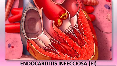 Endocarditis Youtube