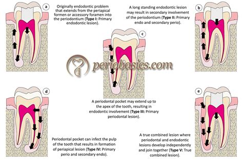 Endodontic Classification