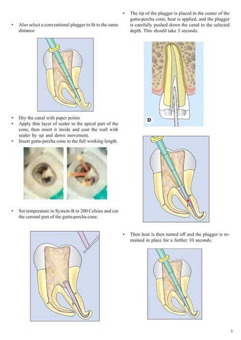 Endodontic Obturation