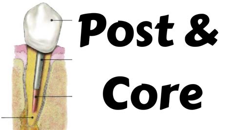 Endodontic Post And Core