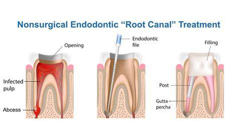 Endodontics Root Meaning