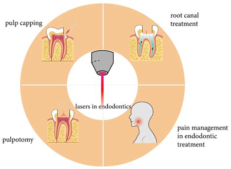 Endodontics Steps
