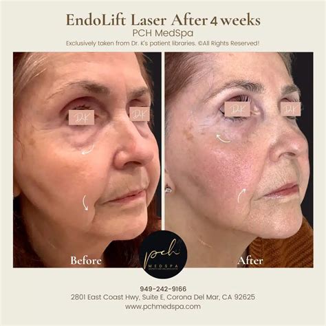 Endolift Laser