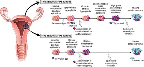 endometrial cancer stage 1 grade 3 forum