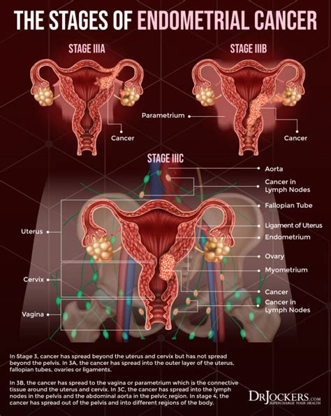 endometrial cancer vs endometriosis